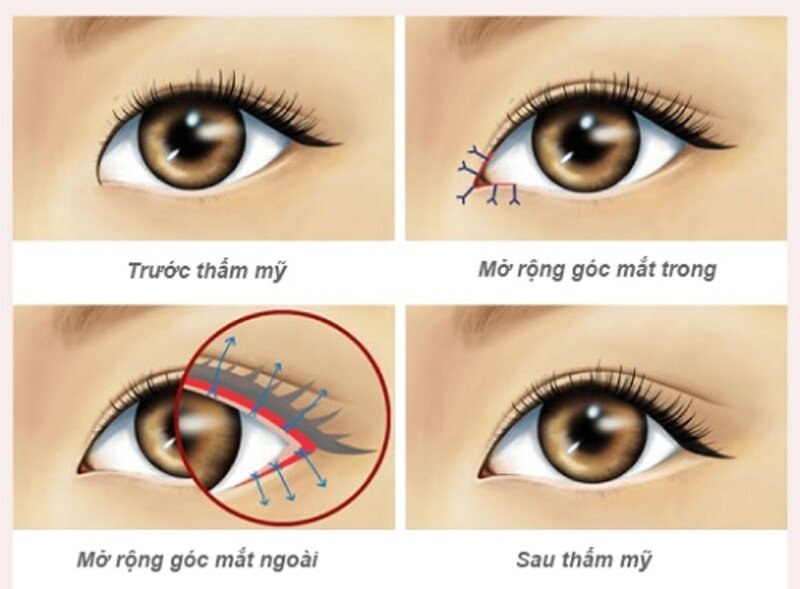 Cắt mí mở góc mắt đang dần phổ biến với chị em phụ nữ (Nguồn: Internet)