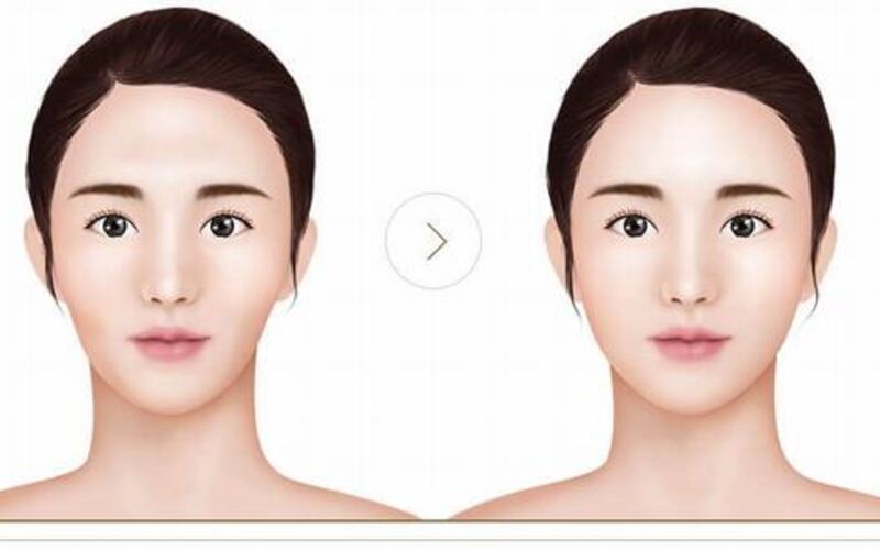 Cấy mỡ mặt phù hợp cho cả nam và nữ từ 18 tuổi trở lên (Nguồn: Internet)