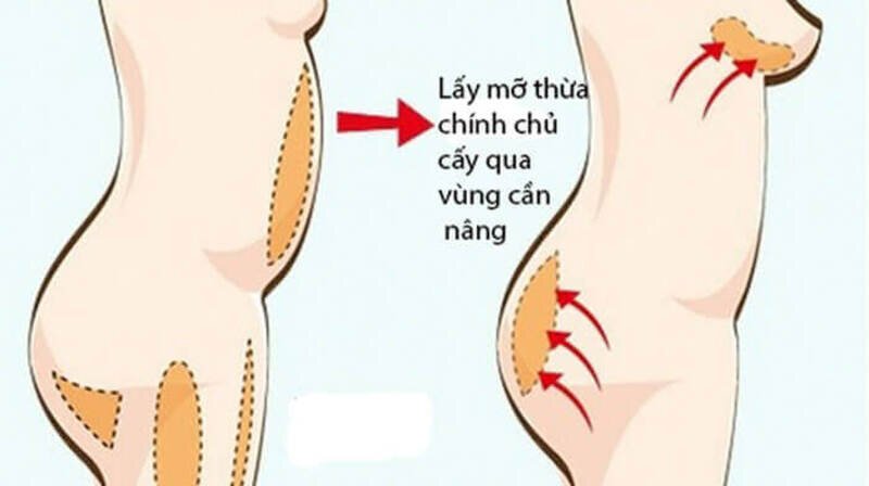 Lấy mỡ thừa chính chủ cấy qua vùng cần nâng (Nguồn: Internet)