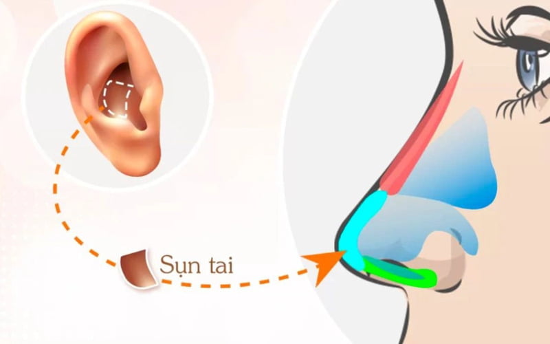Nâng mũi sụn tai (Nguồn: Internet)