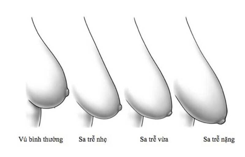 Các mức độ sa trễ ở phụ nữ (Nguồn: Internet)