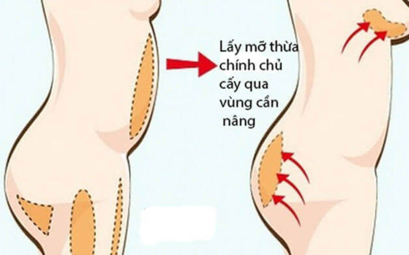 Tham khảo ý kiến bác sĩ về phương pháp nâng mông (Nguồn: Internet)