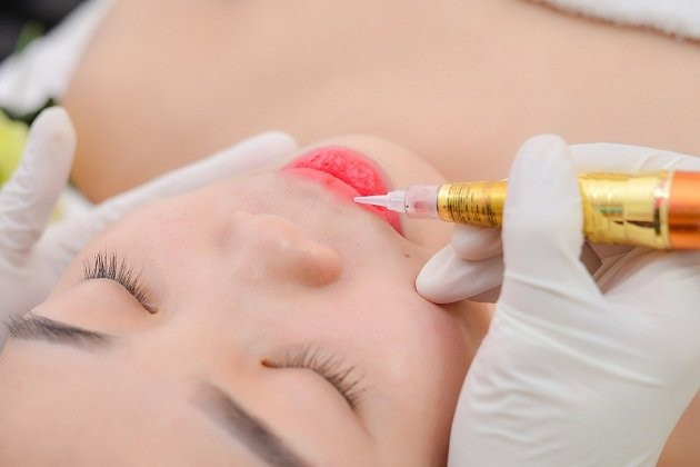 Hình ảnh phun môi collagen (Nguồn:Internet)