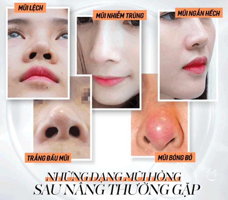 Những trường hợp sửa mũi hỏng sau nâng thường gặp ( Nguồn: Internet )