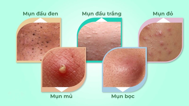 Đặc điểm của các loại mụn viêm (Nguồn: Internet)
